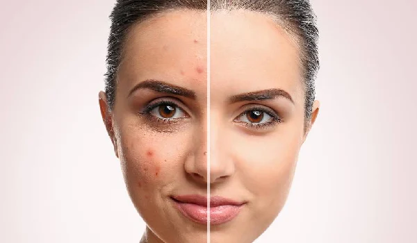 علت جوش صورت در خانم ها