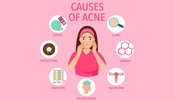 علت جوش در نقاط مختلف صورت