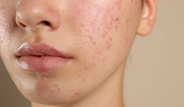 درمان جوش صورت فوری