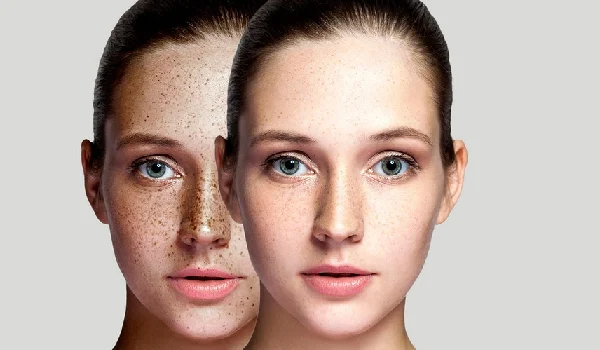 روش های سریع و موثر برای از بین بردن لک های پوستی