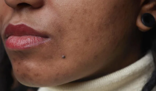 نتایج استفاده از روش های مختلف برای از بین بردن لک ها