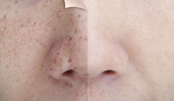 پیشگیری از ایجاد لک های پوستی