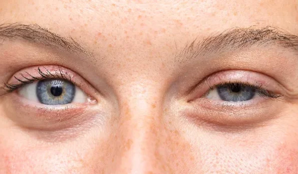 جلوگیری از ورم چشم