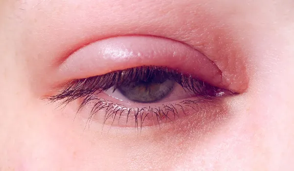 از بین بردن پف زیر چشم فوری