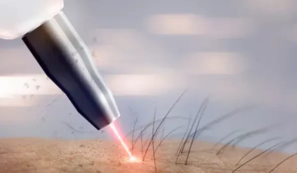 لیزر موهای زائد