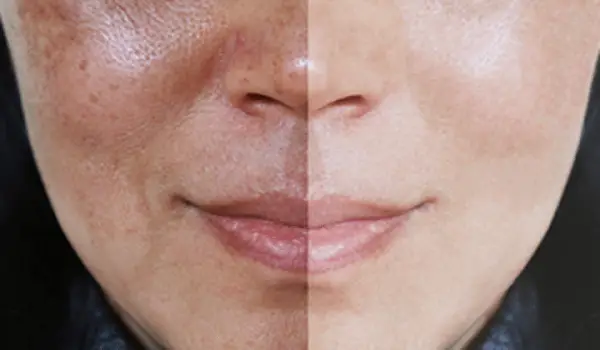 برند کرم ترمیم‌کننده جای جوش ایرانی