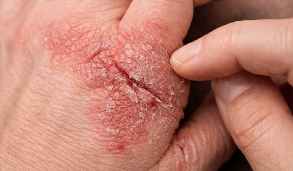 اگزما چیست و چگونه درمان میشود