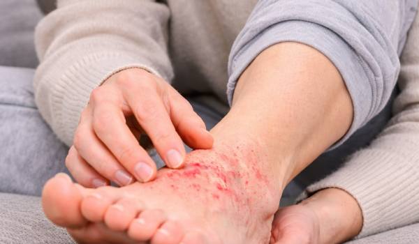 انواع اگزما