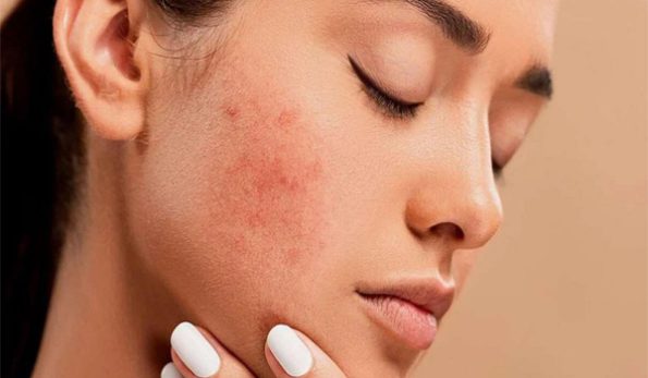 روتین پوستی برای پوست چرب با حداقل هزینه