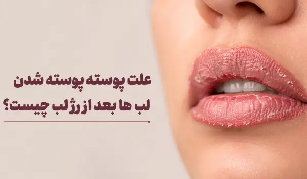 علت پوسته پوسته شدن لب ها بعد از رژ لب چیست؟